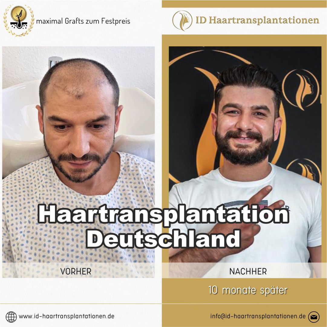 ID Haartransplantationen