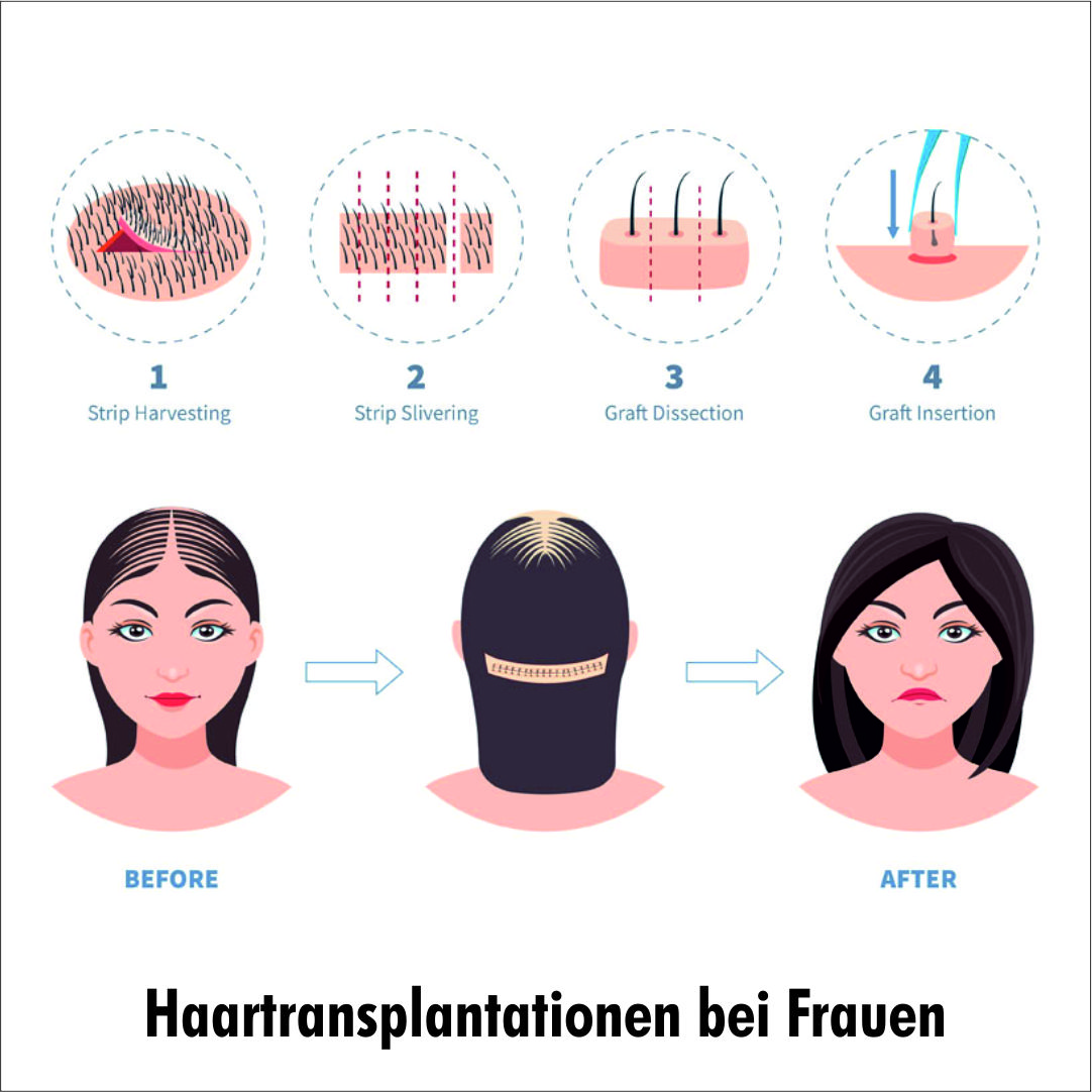 ID Haartransplantationen