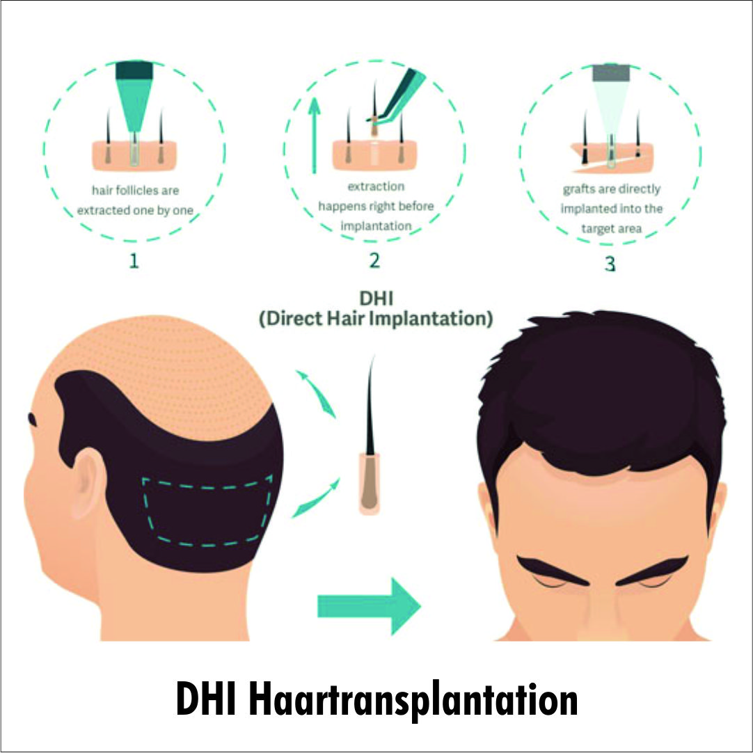 ID Haartransplantationen