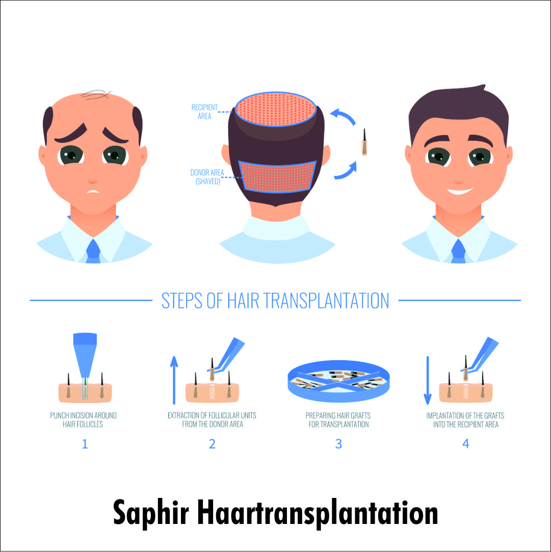 ID Haartransplantationen