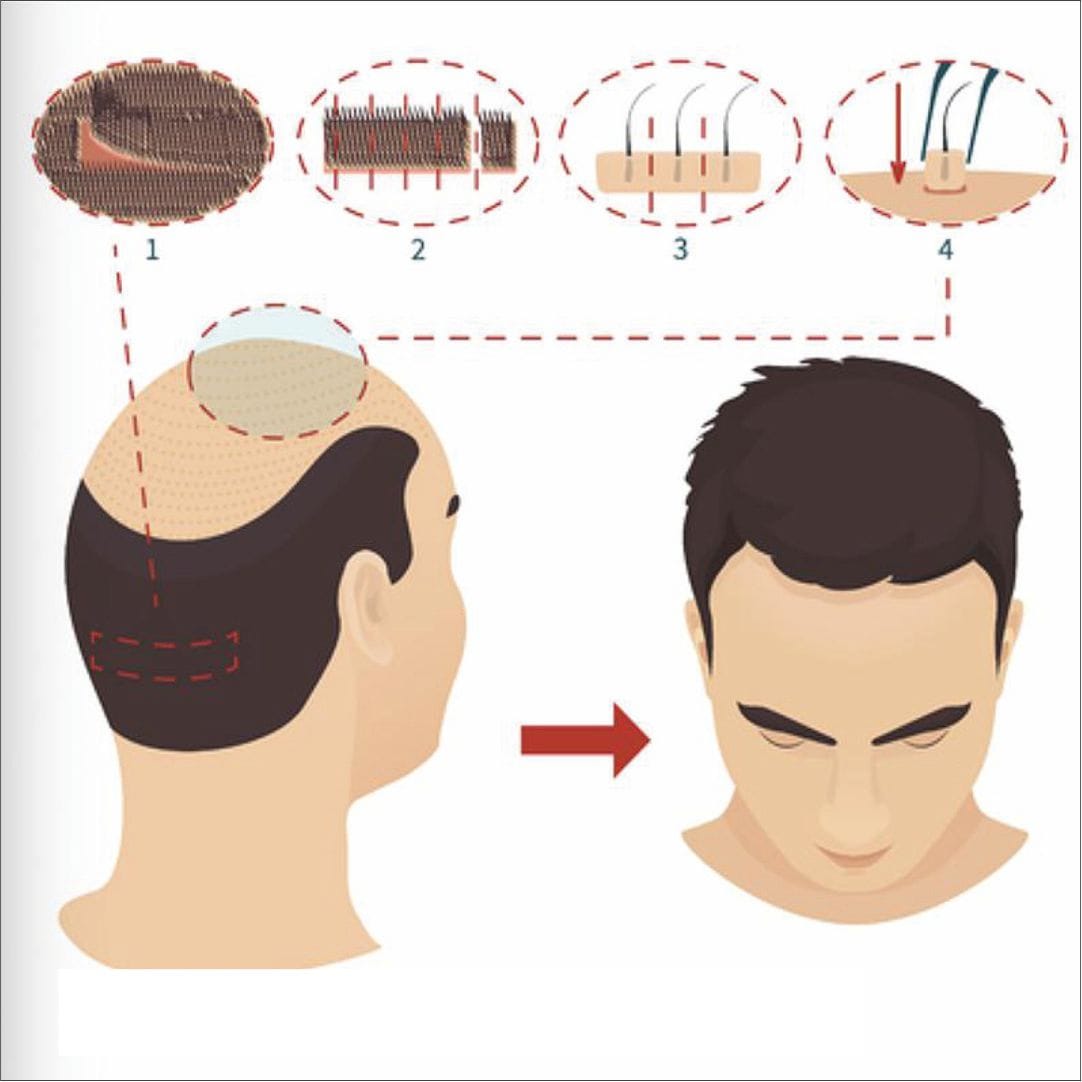 Haartransplantation Mannheim Preise 2025 – Was kostet eine Haartransplantation?