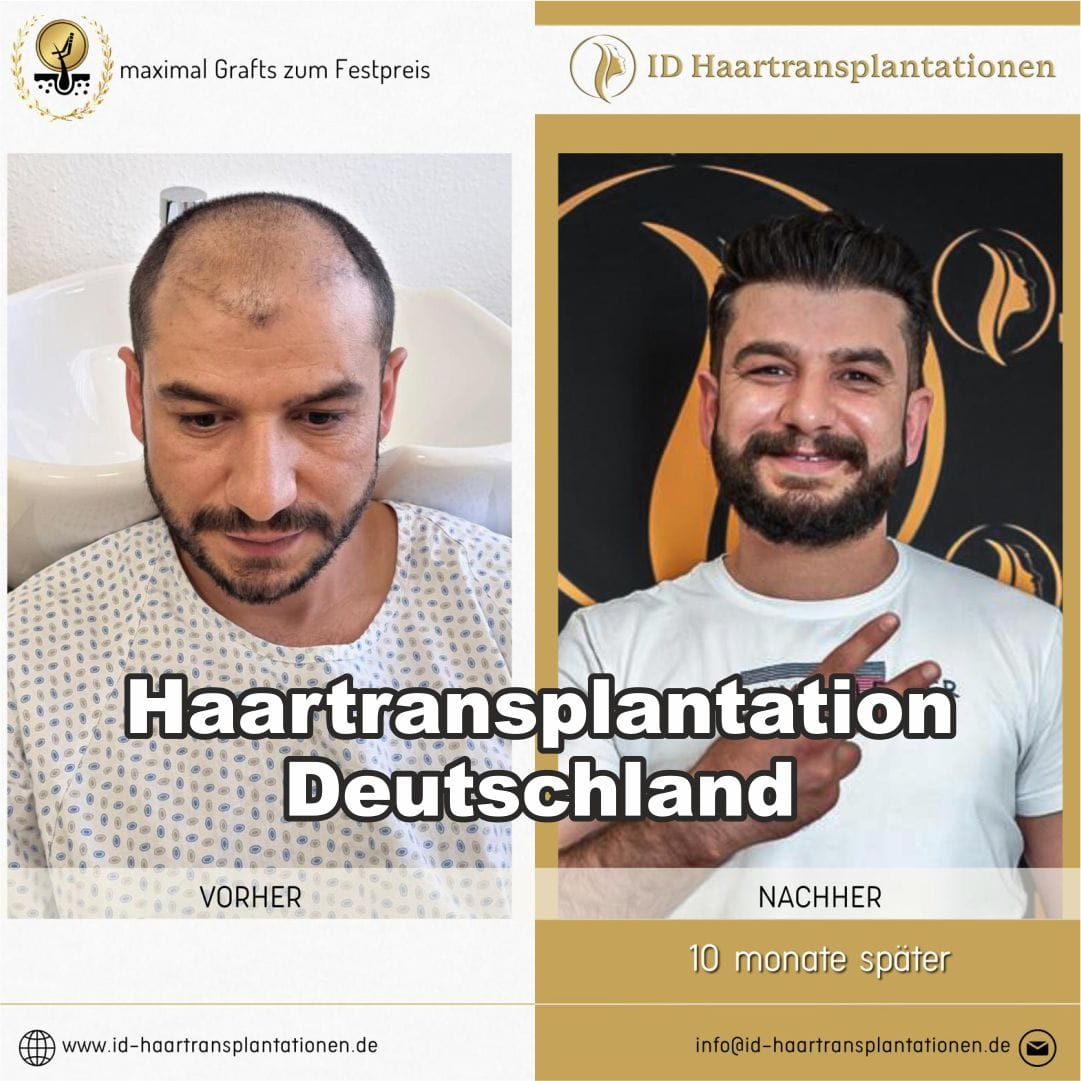 Haartransplantation Deutschland Empfehlung: