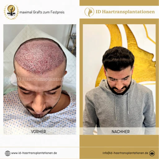 Wie viel kostet 3000 Haartransplantation in der Türkei? – Fakten & Tipps