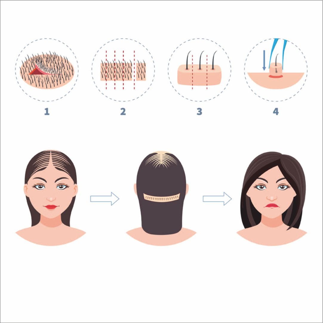 Haarverpflanzung Frauen – Natürliche Lösungen bei Haarausfall