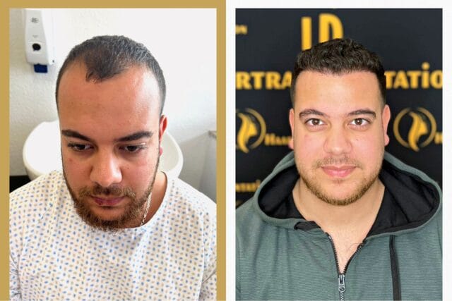 Haartransplantation Mannheim Preise