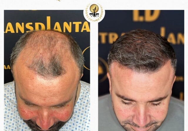 Haartransplantation Mannheim – Das sollten Sie wissen, bevor Sie sich entscheiden!